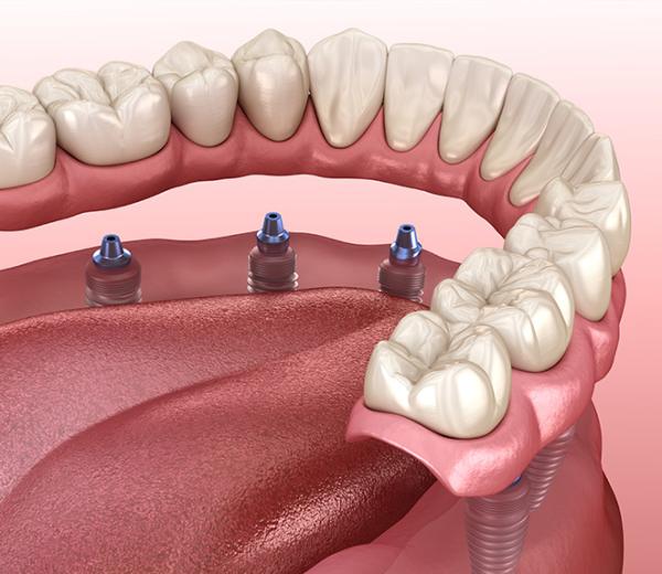 denture implant