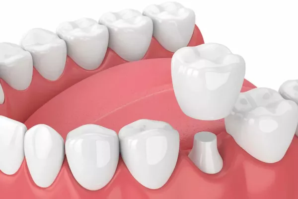 Rendering of dental crown