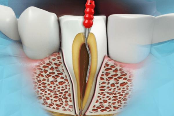 Rendering of root canal procedure